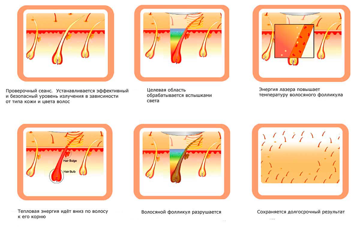 Лазерная эпиляция. Принцип действия